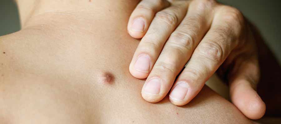 Cyst Removal Surgery Cost Near Me in Phoenix AZ Cyst Removal Surgery Cost Near Me in Phoenix AZ
