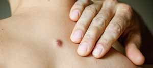 Cyst Removal Surgery Cost Near Me in Phoenix AZ Cyst Removal Surgery Cost Near Me in Phoenix AZ