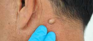 Cyst Removal Surgery Specialist Near Me in Phoenix AZ Cyst Removal Surgery Specialist Near Me in Phoenix AZ