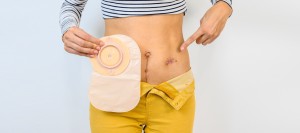 Who Is a Candidate for Colostomy Reversal in Phoenix, AZ?