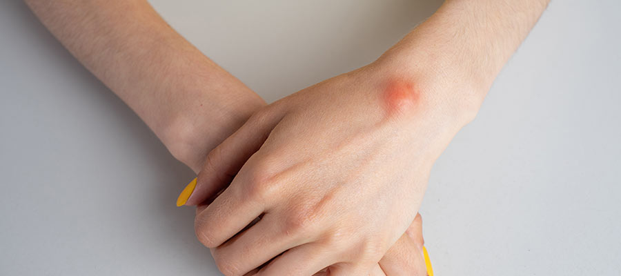 How Are Lipomas and Common Skin Growths Treated in Phoenix, AZ? How Are Lipomas and Common Skin Growths Treated in Phoenix, AZ?