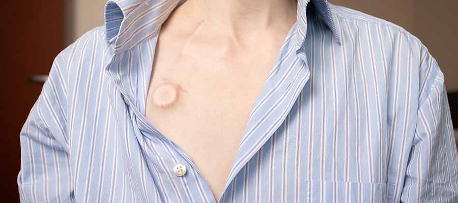 What Should Patients Know About Port Placements for IV Access in Phoenix, AZ? What Should Patients Know About Port Placements for IV Access in Phoenix, AZ?