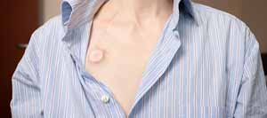 What Should Patients Know About Port Placements for IV Access in Phoenix, AZ? What Should Patients Know About Port Placements for IV Access in Phoenix, AZ?